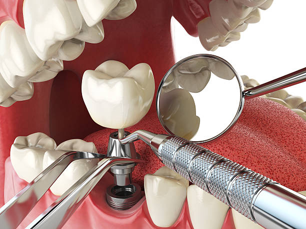Best Emergency Root Canal Treatment in Raleigh Hills, OR